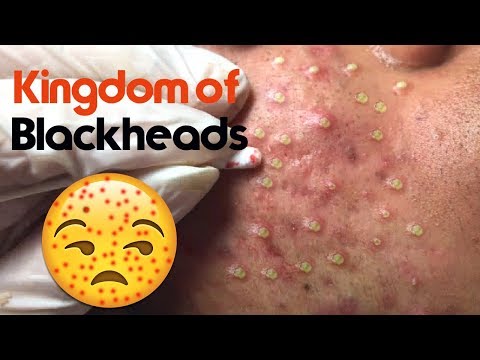 Blackheads, Cystic Acne, & Pimples Extraction On Face, Acne Treatment! 