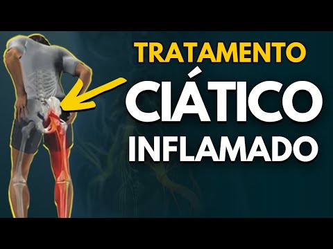 COMO TRATAR O CIÁTICO INFLAMADO? Exercícios para alívio da dor