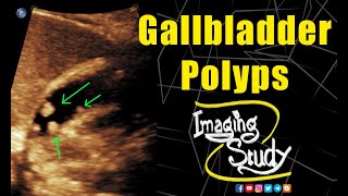 Gallbladder Polyps || Ultrasound || Case 136