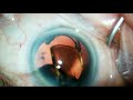 Medicel Soft Tip IA (Zia Carrim, Consultant Ophthalmologist)