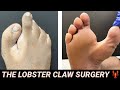 AMAZING LOBSTER CLAW SURGERY TRANSFORMATION ** EXTREMELY GRAPHIC ** FOR EDUCATIONAL PURPOSES