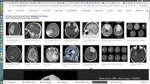 Brain Tumor Classification|  +91-9872993883 for query| CNN Bottleneck TensorFlow |