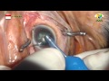 Hard cataract with small pupil  phaco surgery 1222