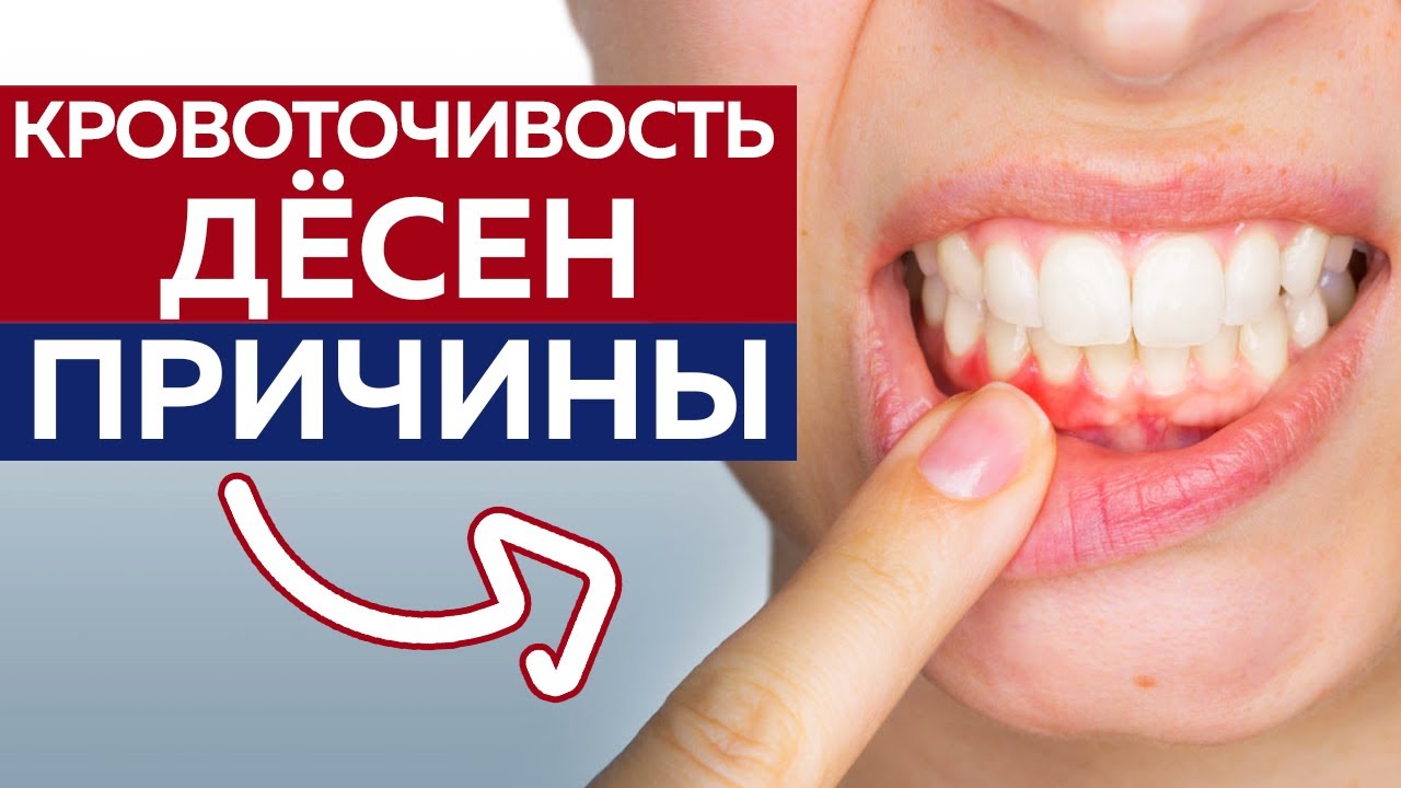 Кровоточивость десен причины. Кровоточивость десен при чистке зубов.