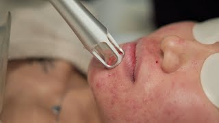 See The Ultraclear Laser Experience Real People, Real Reactions, Real Confidence