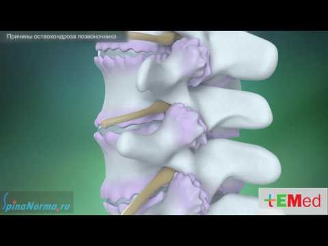 Причины остеохондроза позвоночника