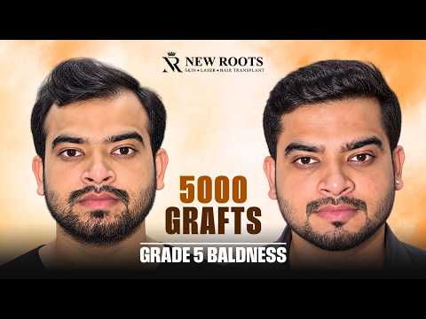 This Hairline Looks TOO NATURAL! 😱 | Grade 5 Baldness | Hair Transplant in Raipur | Cost & Results