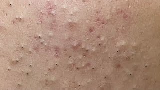 Acne treatment for Spa Linh Mun 2023 #042