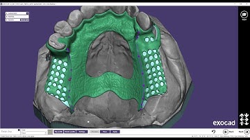 Removable partial frame for using wax milling in Korea partial frameworks