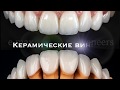 Препаровка под виниры. Карнеев Андрей - врач стоматолог ортопед.
