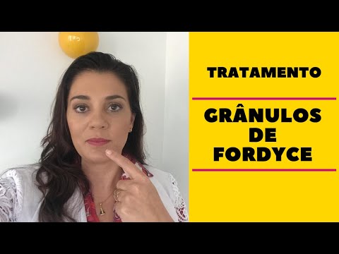 Vídeo: Grânulos De Fordyce - Causas, Tratamento, Remoção