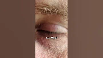 رجفان العين المفاجئ 