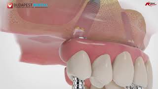 Teljes Kivehető Fogsor Helyett Fix Fogak