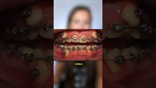 Si tienes los dientes muy APIÑADOS, este time lapse de brackets te va a INTERESAR Resimi