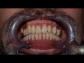 Restoration of dental implants within 24 hours. Papadent Clinic in Vilnius