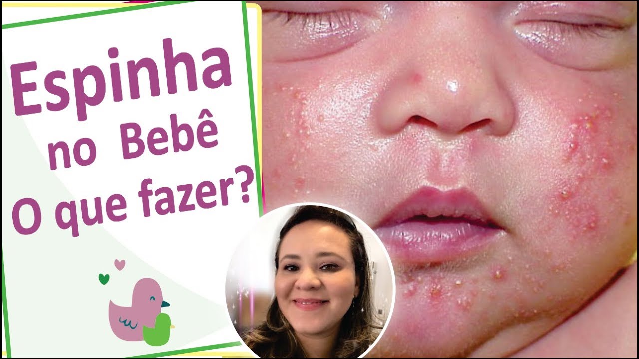 BEBÊ COM ESPINHA - ACNE NEONATAL - VEM SEM MANUAL - RENATA PEREIRA ...