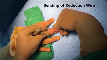 SUZUKI FRAME - THE PINS AND RUBBERS (P&R) TRACTION SYSTEM  FOR PIP JOINT FRACTURE DISLOCATION