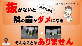 「抜かないと隣の歯がダメになる」というのは、抜きたい歯医者のレトリックです。