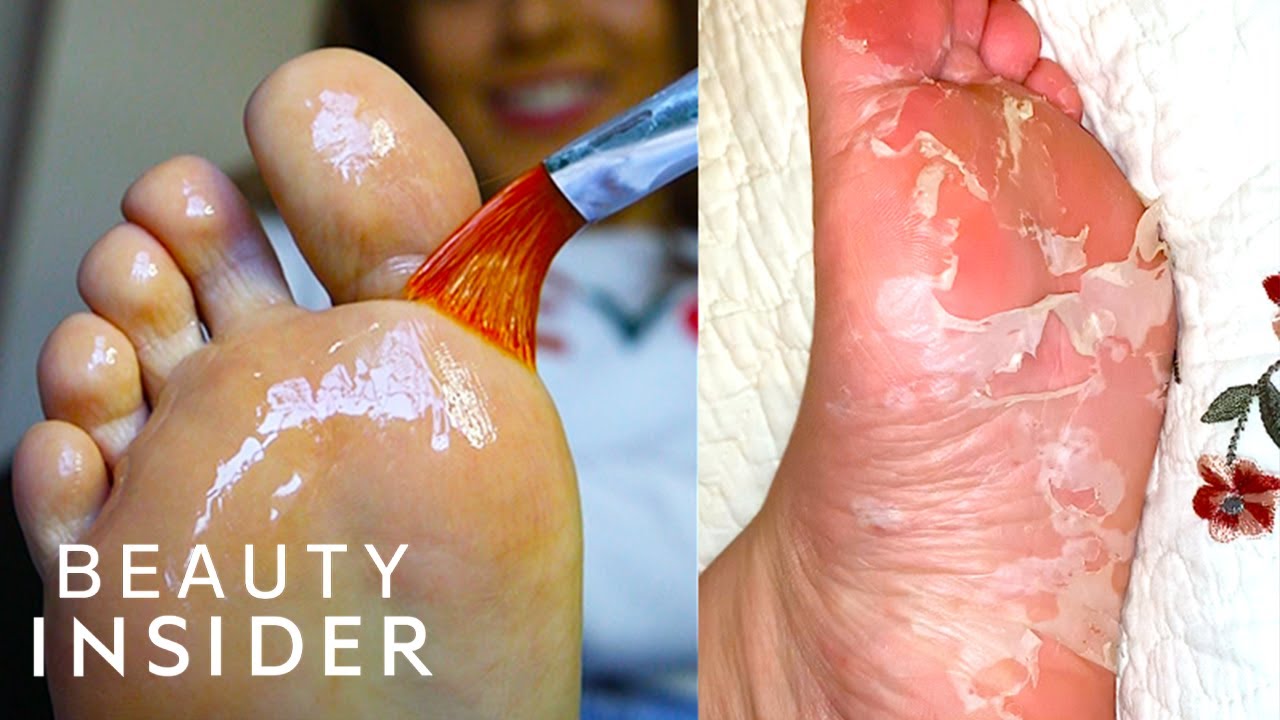 Chemical Peel For Your Feet Removes Crusty Skin | Beauty Explorers