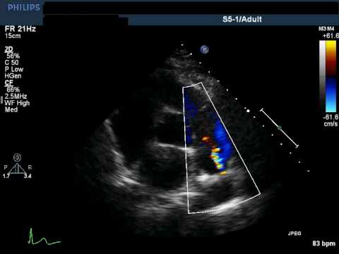 Ductus arteriosus patent adult sorry, that Opinion Ductus arteriosus patent adult are