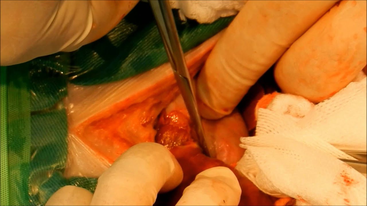 colecistectomia. caninos. - YouTube