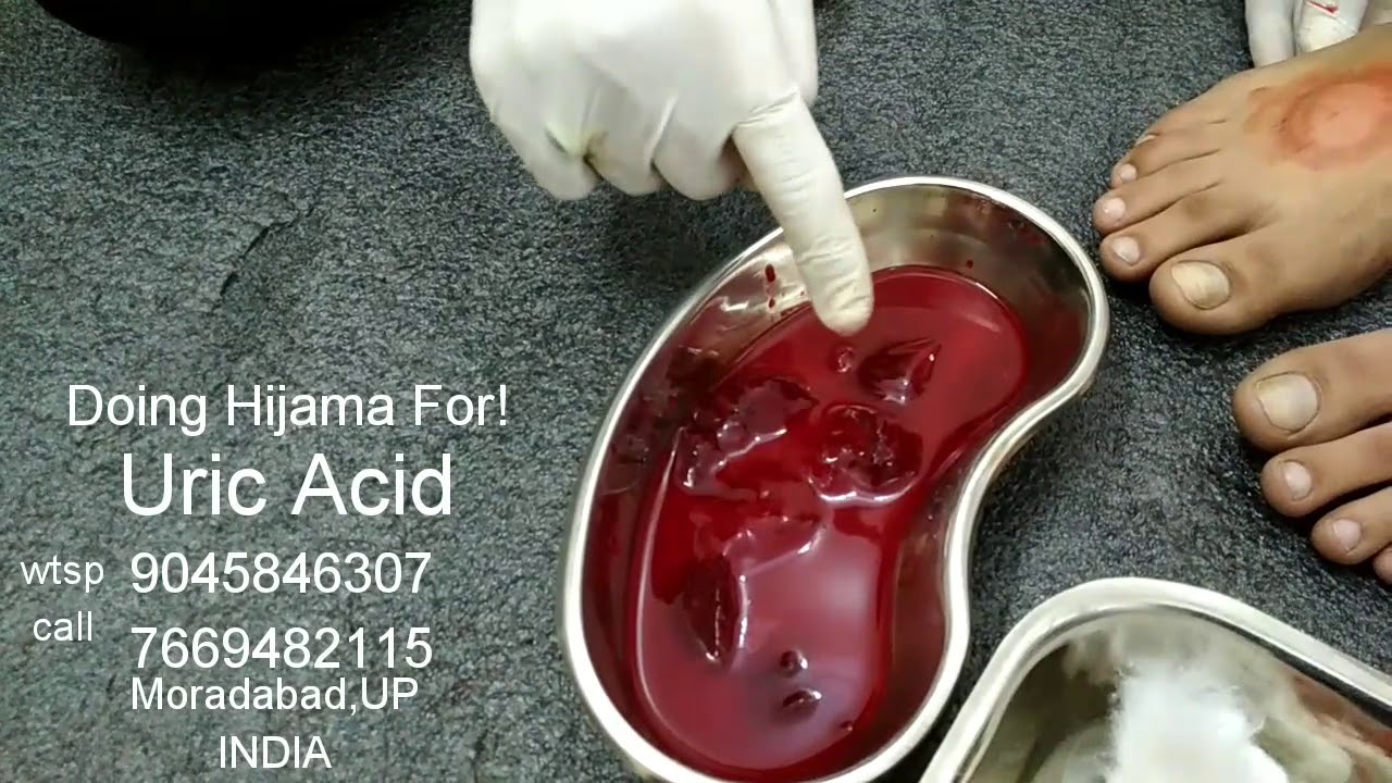 Hijama for Uric Acid, Joint Pain Arthritis (Cupping therapy