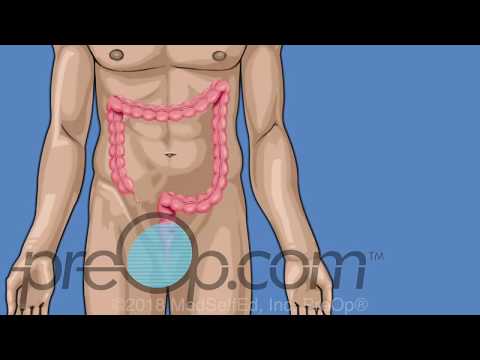 Upper Endoscopy Upper GI Procedure Nebraska Patient Education. Upper Endoscopy Upper GI Procedure Nebraska Patient Education.