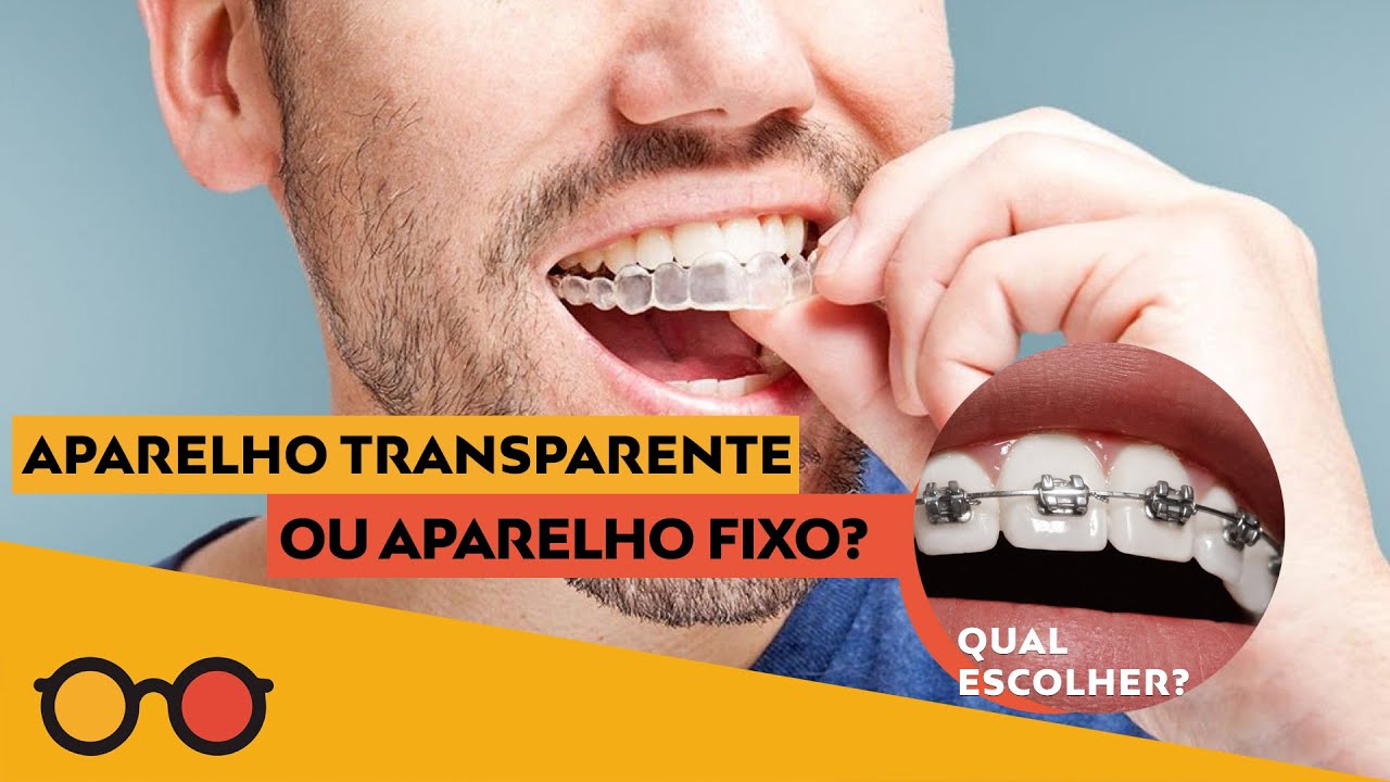 Aparelho transparente ou fixo? Qual escolher? l Plantão de Dúvidas 