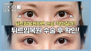 뒤트임복원 후 어떻게 변할까? 케이스별로 확인! [뒤트임부작용 개선방법]