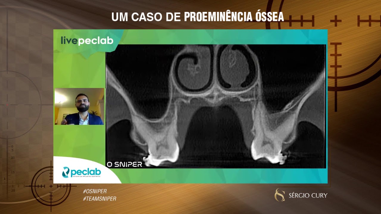 O Que é Proeminência óssea - BRAINCP