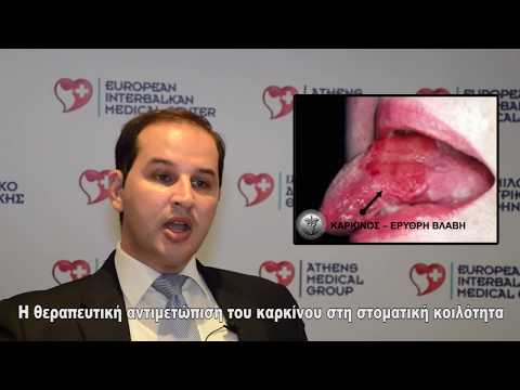 Βίντεο: Καρκίνος του στόματος (Gingiva Fibrosarcoma) σε σκύλους