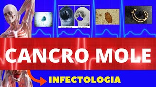 CANCRO MOLE - CAUSAS, SINTOMAS, DIAGNÓSTICO E TRATAMENTO - INFECTOLOGIA