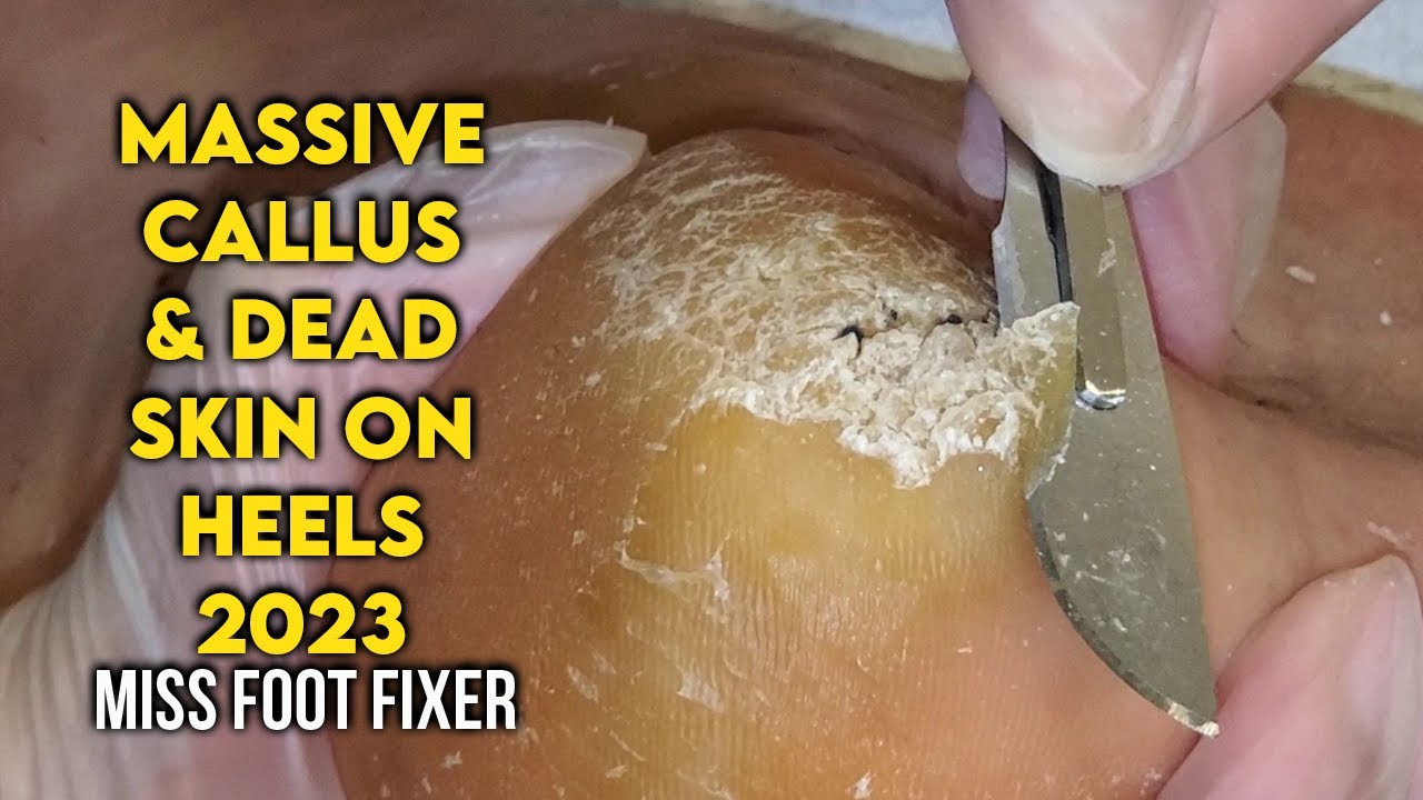 SCRAPING OF MASSIVE CALLUS & DEAD SKIN FROM HEELS 2023 BY FOOT