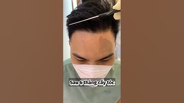Ca cấy tóc cho khách hàng rụng tóc, hói đầu điển hình