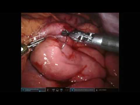 ligament of trietz ulcer