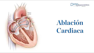¿Puede una ablación provocar insuficiencia cardíaca?