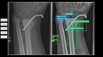 Bone Fracture Detection App