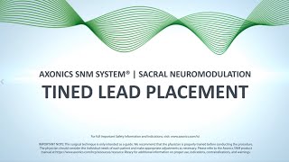 Tined Lead Procedure | Axonics SNM System®