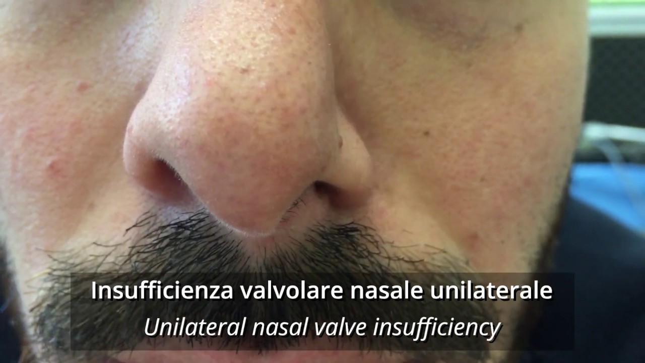 Insufficienza della valvola nasale, dilatatore nasale vs cerotto nasale -  YouTube