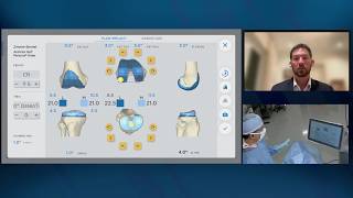TMINI® Miniature Robotic System with Persona® OsseoTi® Keel Tibia and PPS® Femur