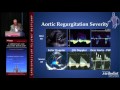 Aortic Regurgitation (Miguel Quiñones, MD)