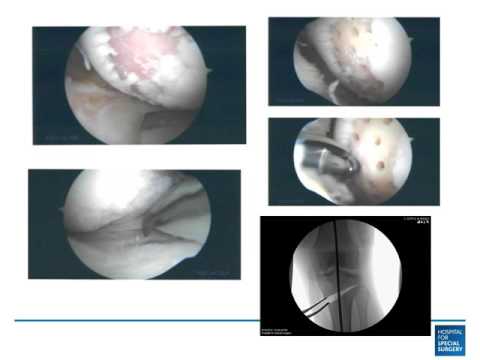 Bowleg Realignment with Tibial Osteotomy - Bowleg Realignment with Tibial Osteotomy