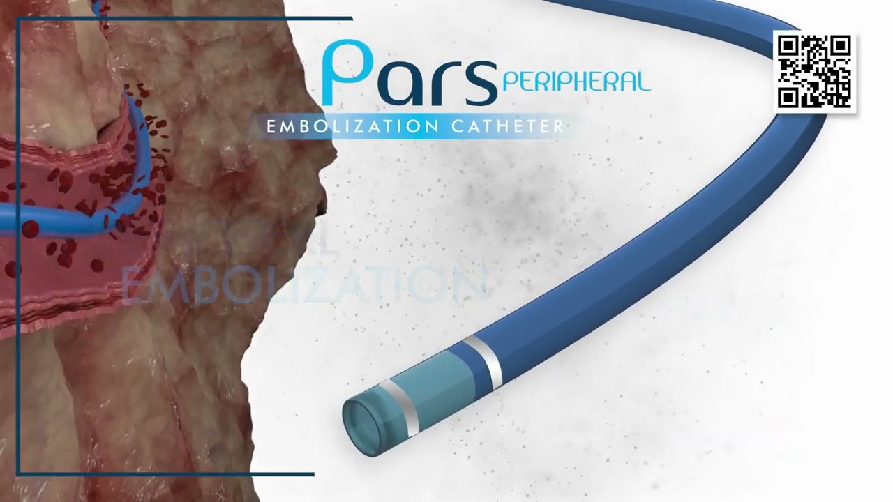 PARS® by INVAMED | Peripheral Embolization Catheter for Vascular and Oncologic Interventions