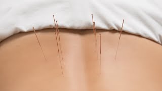 Precision Acupuncture Shows Powerful Results for Low Back Pain Relief