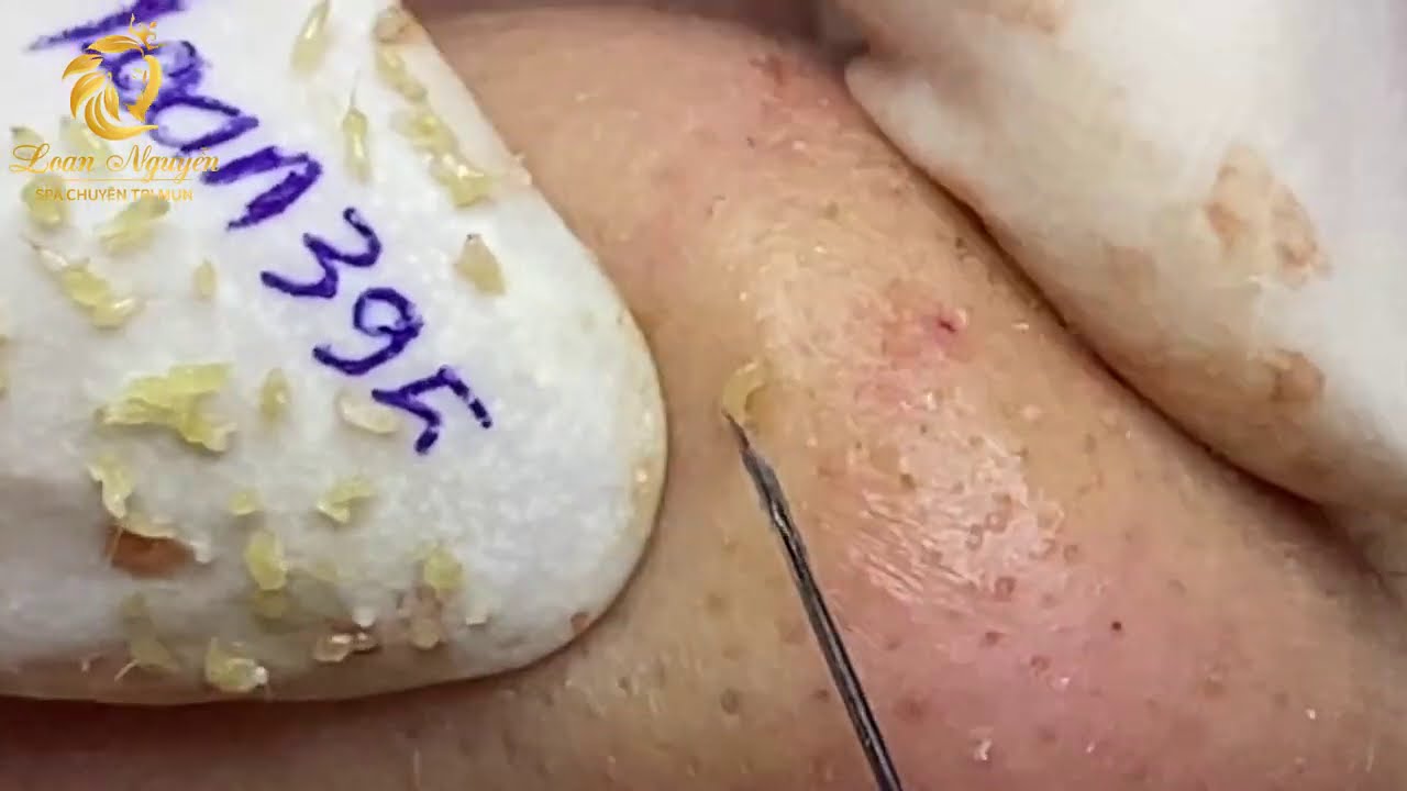 Treatment of blackheads and whiteheads (395) | Loan Nguyen