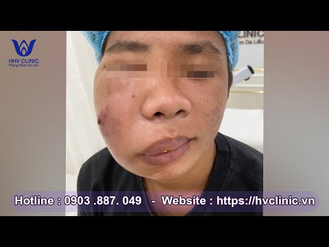 ĐIỀU TRỊ MỤN VIÊM TỤ CẦU SIÊU TO KHỔNG LỒ - TẠI HHV CLINIC | Đỗ Thu Hiền |