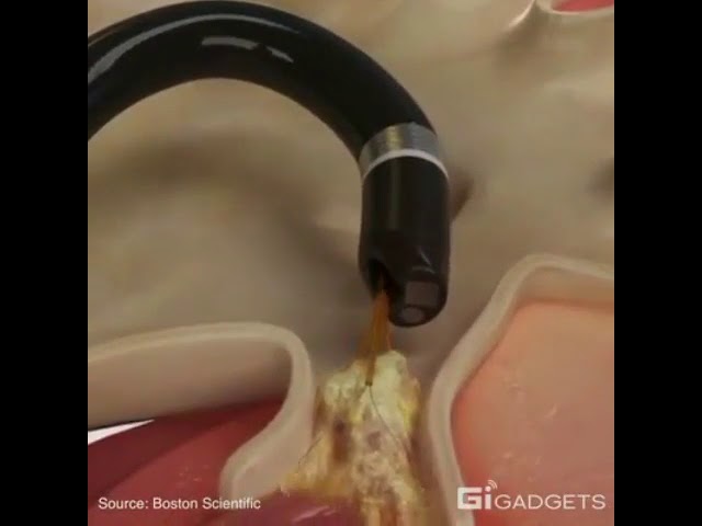 Современный метод удаления камней из почек