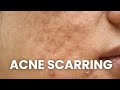 Heres how you can reduce your acne scarring