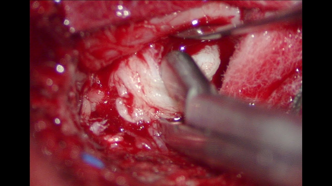 Surgery for Cauda Equina Syndrome YouTube