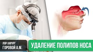 Удаление полипов в носу шейвером. Как проходит операция в клинике Москвы. ЛОР врач Горовой Ал-др